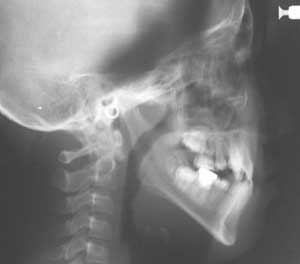 頭部X線規格写真（セファログラム）