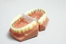 舌側矯正装置（リンガルブラケット装置）